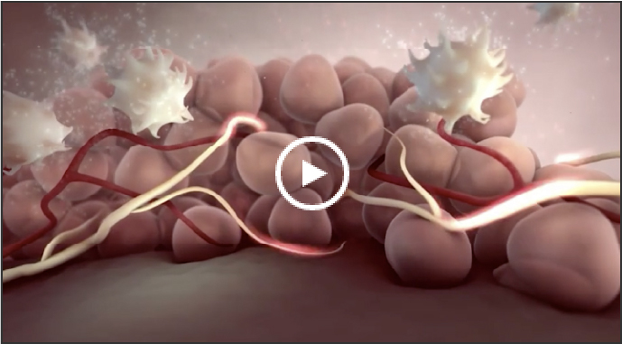 Endometriosis etiology