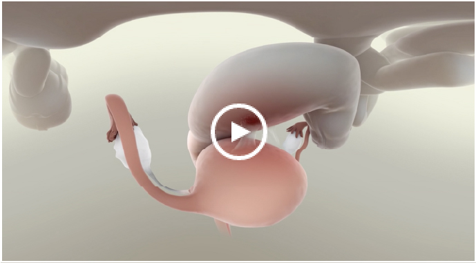 Illustration of rectovaginal lesions in endometriosis