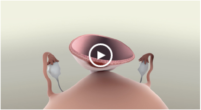 Illustration of rectosigmoid lesions in endometriosis