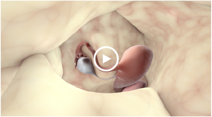 Illustration of chocolate cysts in endometriosis