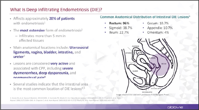 Illustration defining deep infiltrating endometriosis