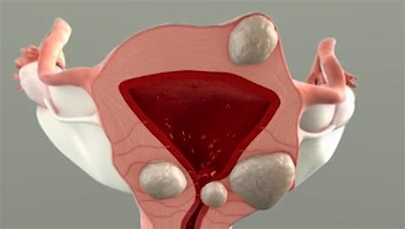 The decrease in quality of life can correlate to the hemoglobin level or the consequence of anemia