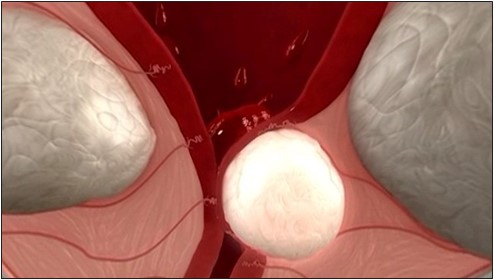 Pulling around the fibroid begins to distort the uterine cavity