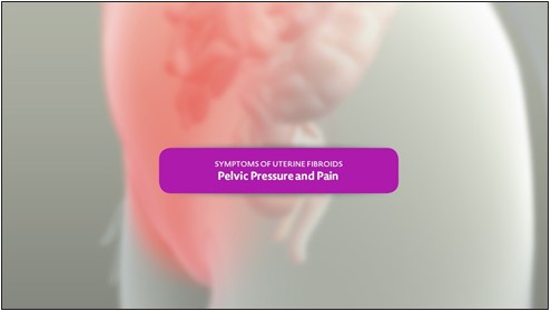 SYMPTOMS OF UTERINE FIBROIDS Pelvic Pressure and Pain