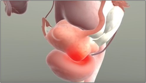 Fibroids that press on the bladder can cause urinary frequency or retention.