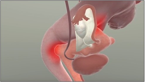 Rotate to posterior subserosal tumor pressing on the rectum. 47