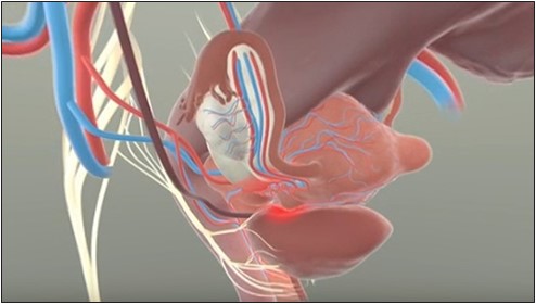 Fibroids can cause pain through compression of pelvic ligaments and nerves.