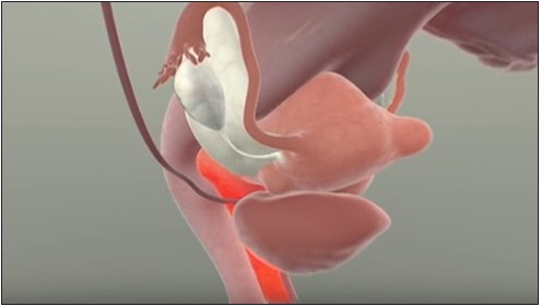 While there are other etiologies that could result in dyspareunia, fibroids can also be the underlying cause, since they compress surrounding structures as they grow.