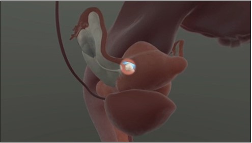 Additionally, fibroids can be associated with infertility.