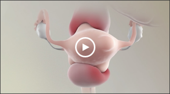 Illustration of uterine fibroids in the uterus