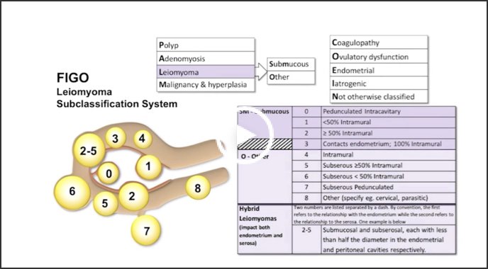 Uterine Fibroids Women s Health Education Digital OBGYN