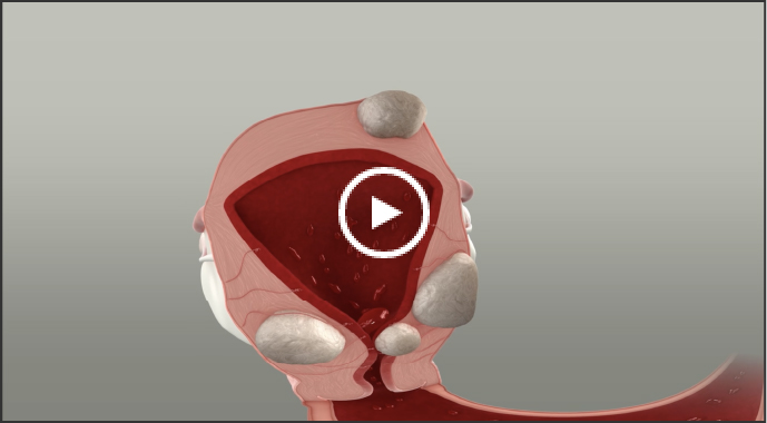 Illustration of heavy menstrual bleeding in uterine fibroids