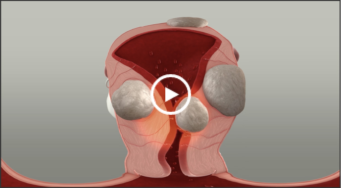 Illustration of uterine fibroids in the uterus