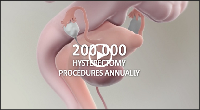 llustration of a uterus with uterine fibroids with the number of 200,000 hysterectomies annually