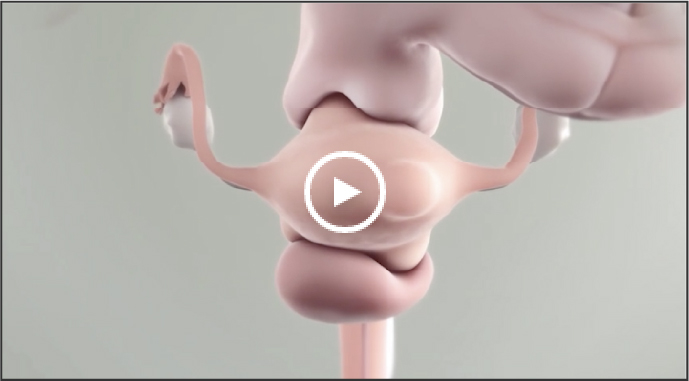 llustration of uterine fibroids in the uterus