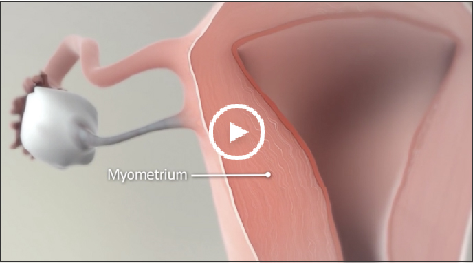  Illustration of the myometrium of the uterus